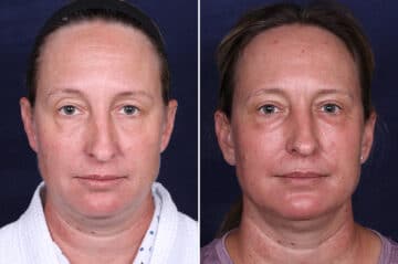 Laser Treatments Before and After Photos in Voorhees Township, NJ, Patient 3982