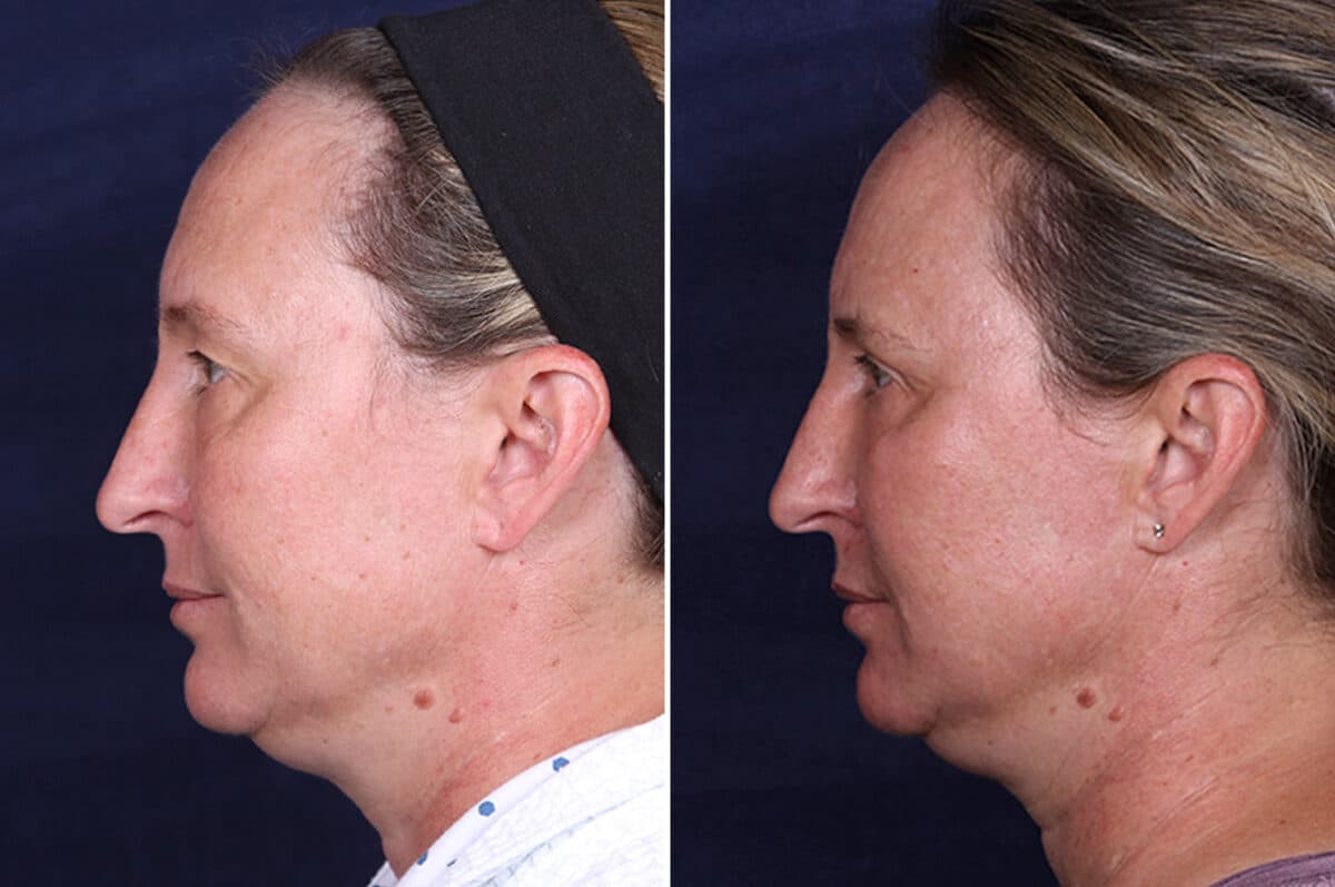 Laser Treatments Before and After Photos in Voorhees Township, NJ, Patient 3982