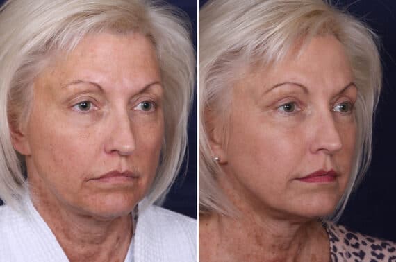 Upper Eyelid Surgery Before and After Photos in Voorhees Township, NJ, Patient 3998