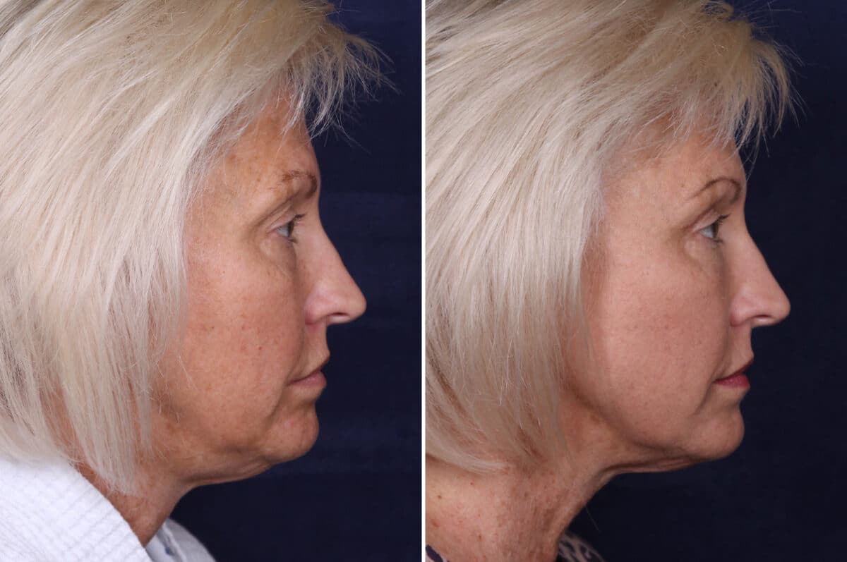 Upper Eyelid Surgery Before and After Photos in Voorhees Township, NJ, Patient 3998