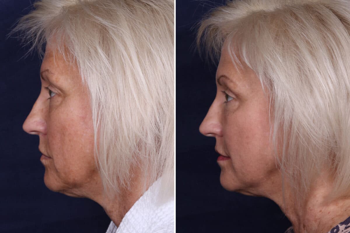 Upper Eyelid Surgery Before and After Photos in Voorhees Township, NJ, Patient 3998