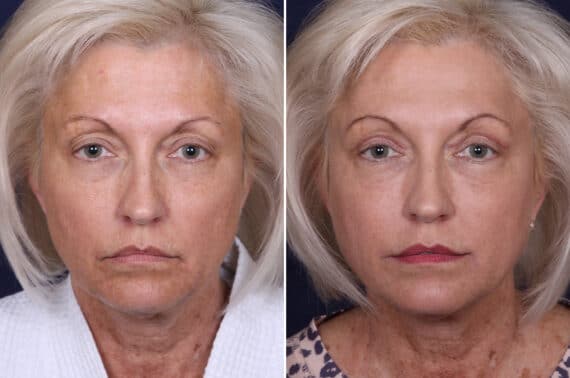 Upper Eyelid Surgery Before and After Photos in Voorhees Township, NJ, Patient 3998