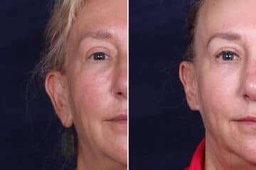 Otoplasty Before and After Photos in Voorhees Township, NJ, Patient 4025