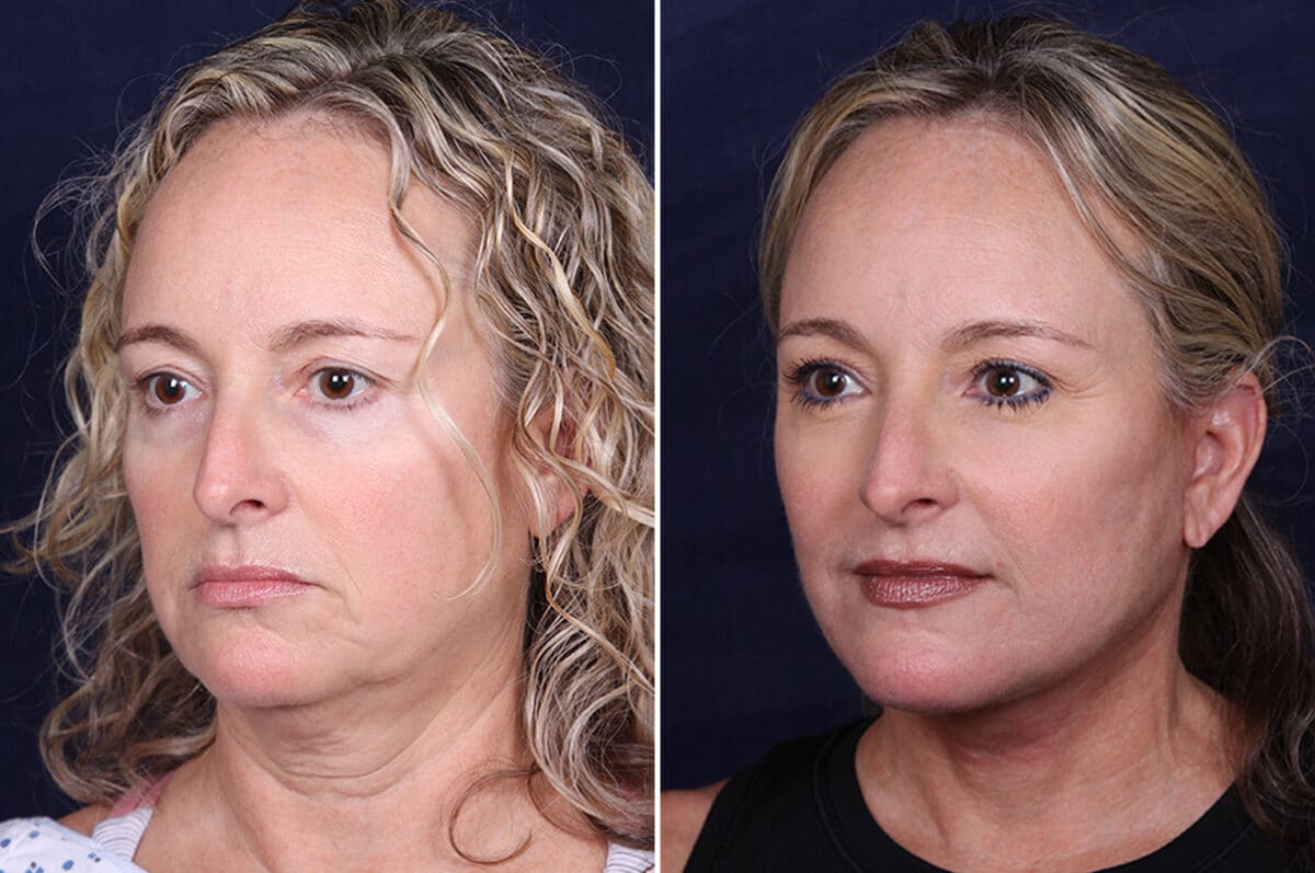 Facelift Before and After Photos in Voorhees Township, NJ, Patient 4029