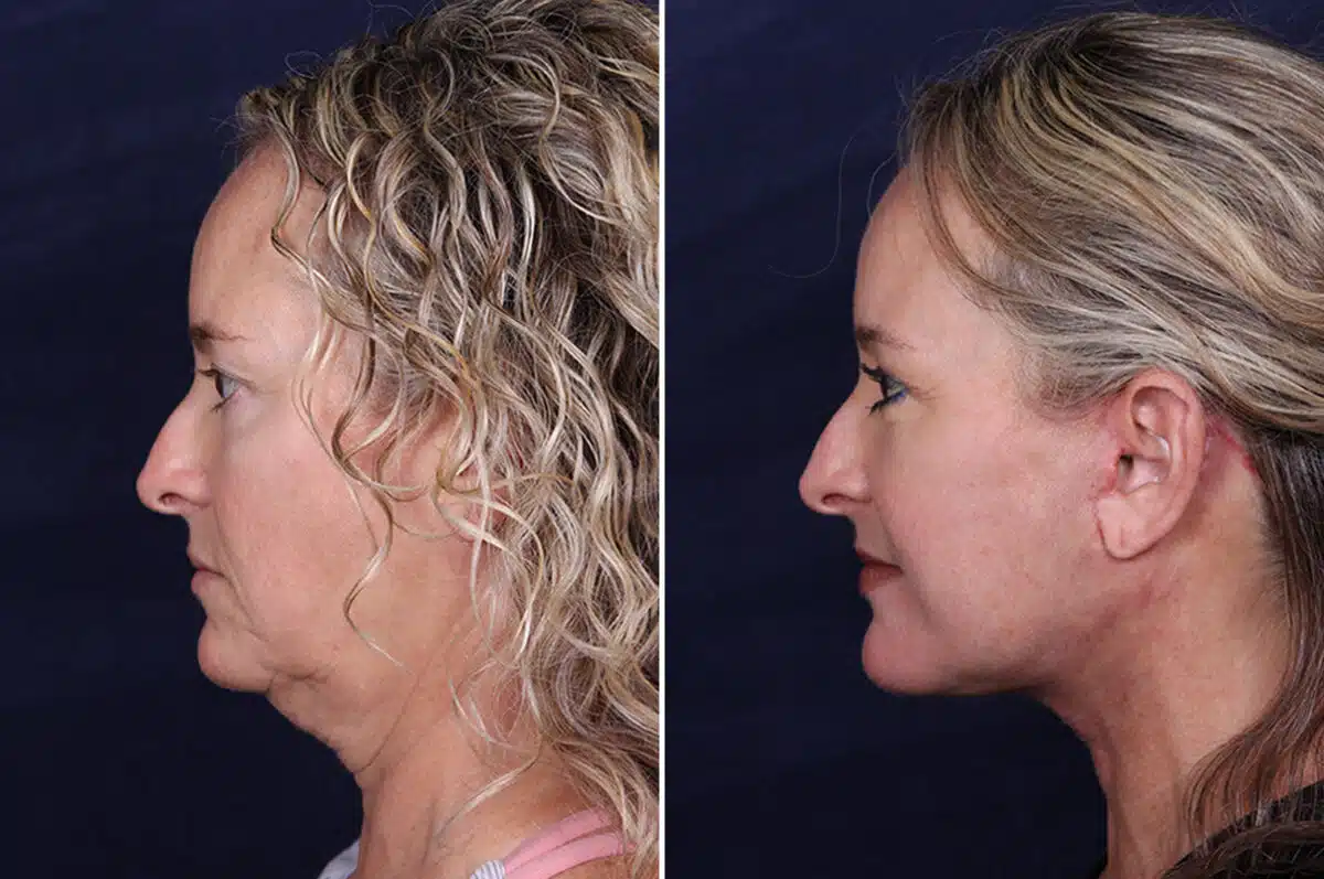 Facelift Before and After Photos in Voorhees Township, NJ, Patient 4029