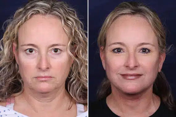 Facelift Before and After Photos in Voorhees Township, NJ, Patient 4029