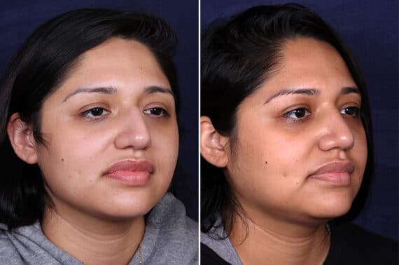 Rhinoplasty Before and After Photos in Voorhees Township, NJ, Patient 4044