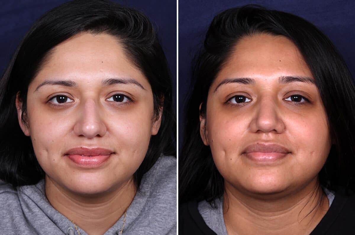 Rhinoplasty Before and After Photos in Voorhees Township, NJ, Patient 4044