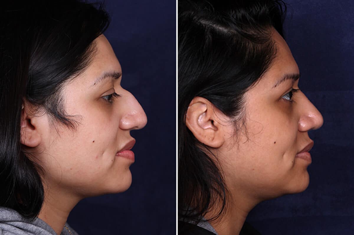 Rhinoplasty Before and After Photos in Voorhees Township, NJ, Patient 4044