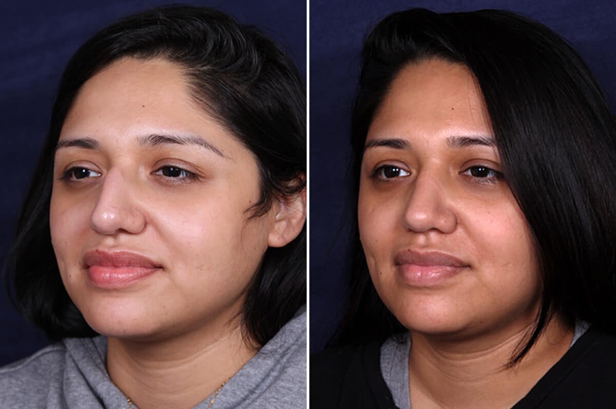 Rhinoplasty Before and After Photos in Voorhees Township, NJ, Patient 4044