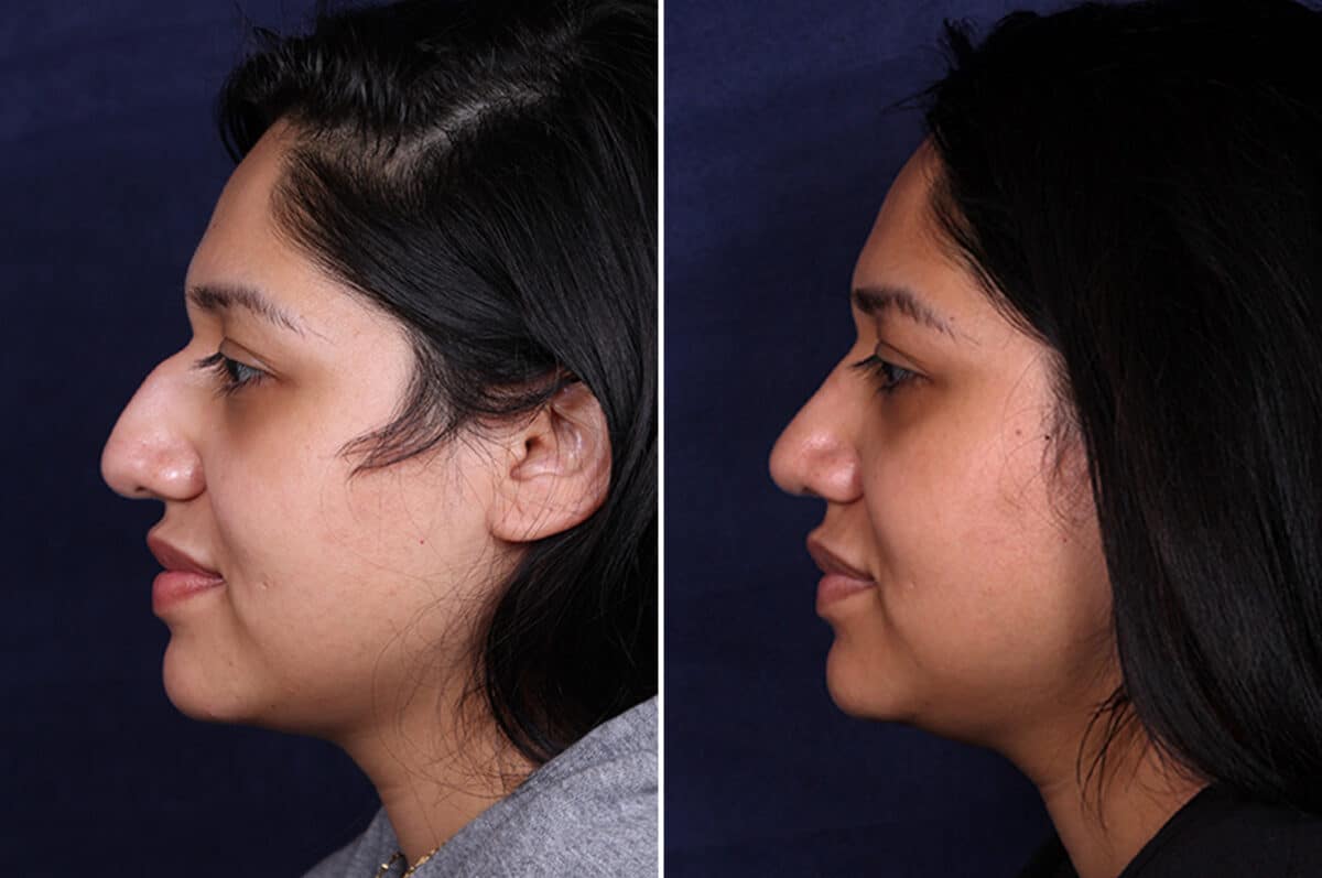 Rhinoplasty Before and After Photos in Voorhees Township, NJ, Patient 4044