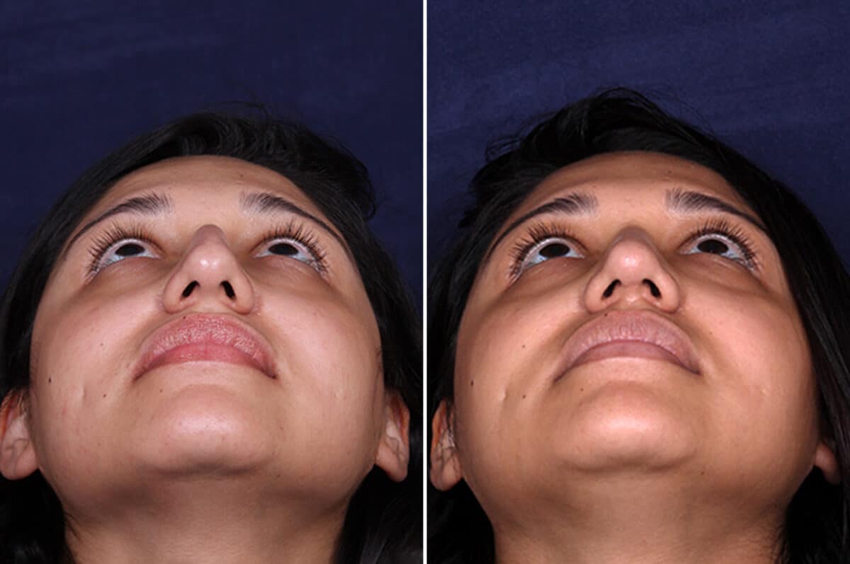 Rhinoplasty Before and After Photos in Voorhees Township, NJ, Patient 4044