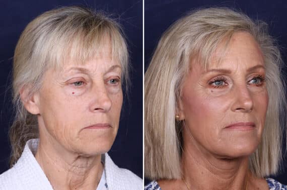 Facelift Before and After Photos in Voorhees Township, NJ, Patient 4063