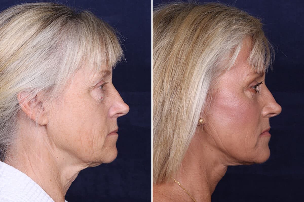 Facelift Before and After Photos in Voorhees Township, NJ, Patient 4063