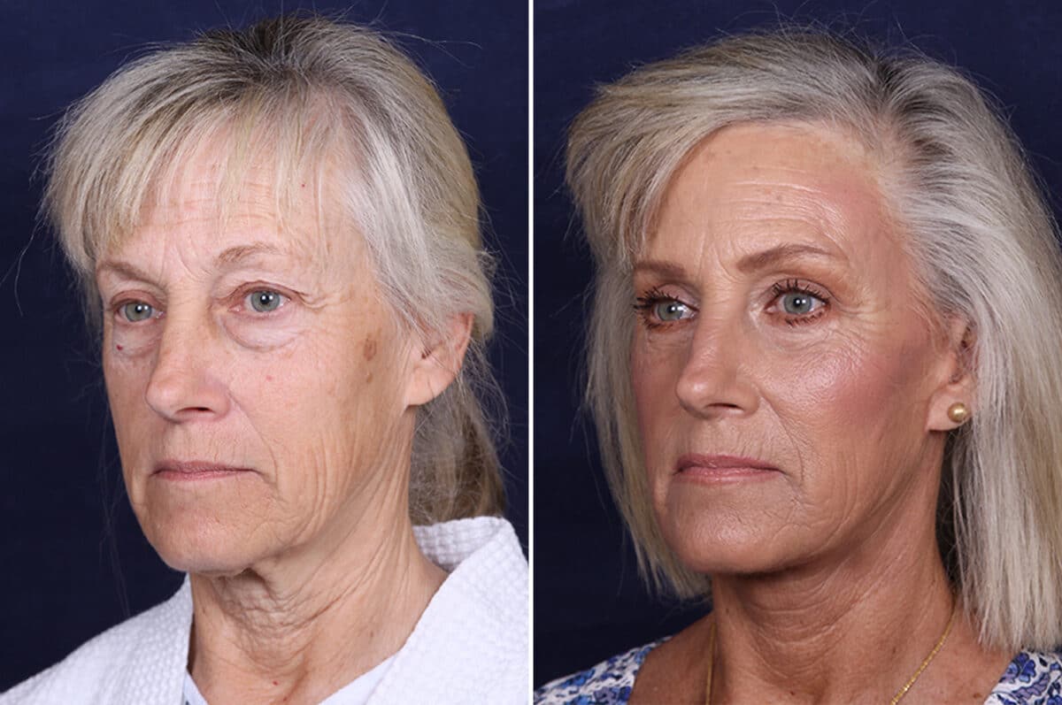 Facelift Before and After Photos in Voorhees Township, NJ, Patient 4063