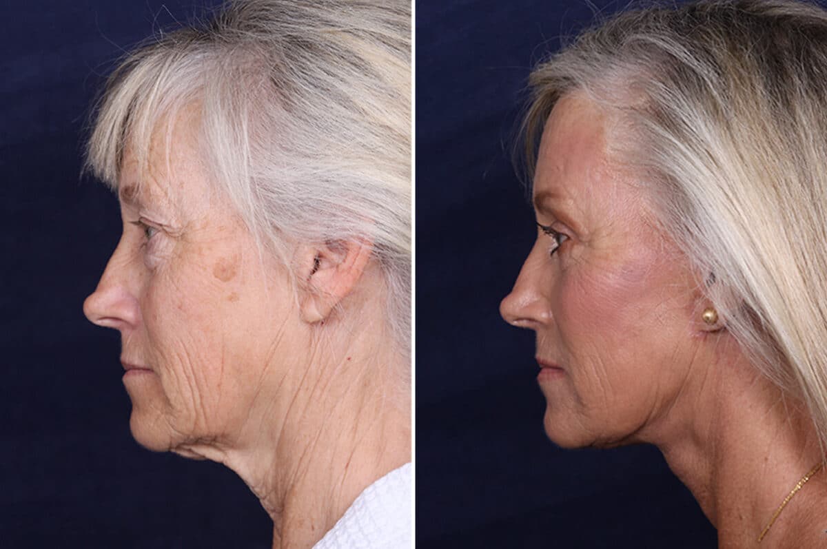 Facelift Before and After Photos in Voorhees Township, NJ, Patient 4063