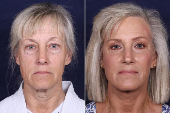 Facelift Before and After Photos in Voorhees Township, NJ, Patient 4063