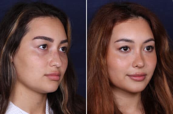 Rhinoplasty Before and After Photos in Voorhees Township, NJ, Patient 4079