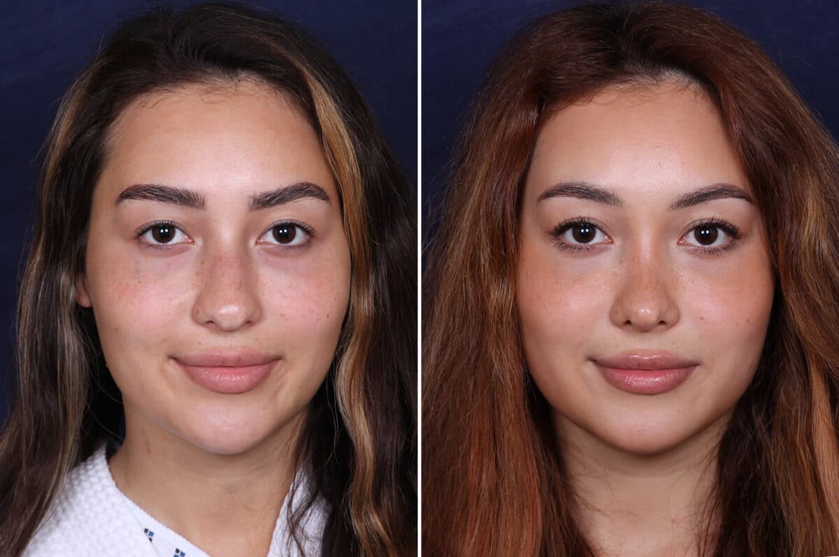 Rhinoplasty Before and After Photos in Voorhees Township, NJ, Patient 4079