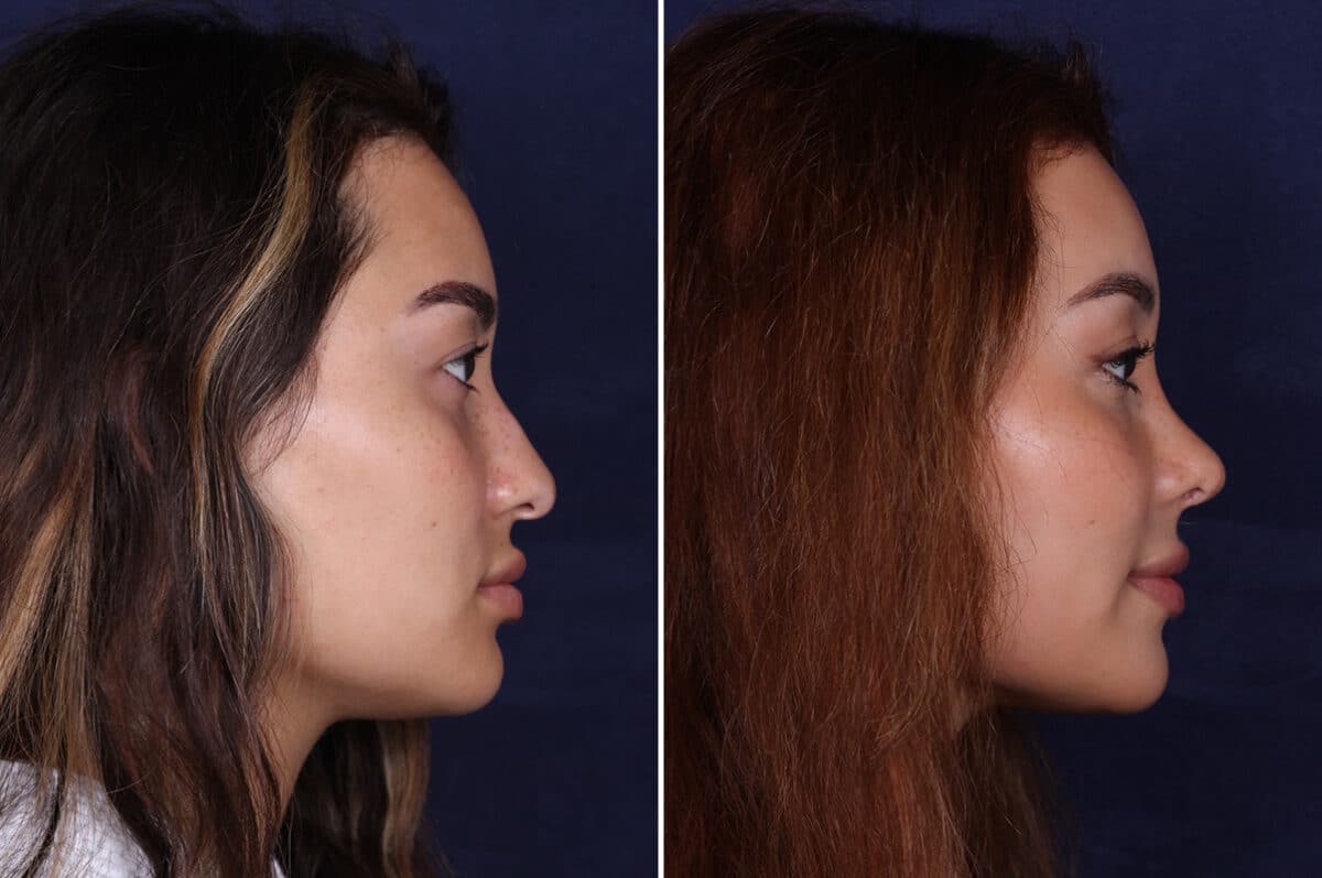 Rhinoplasty Before and After Photos in Voorhees Township, NJ, Patient 4079