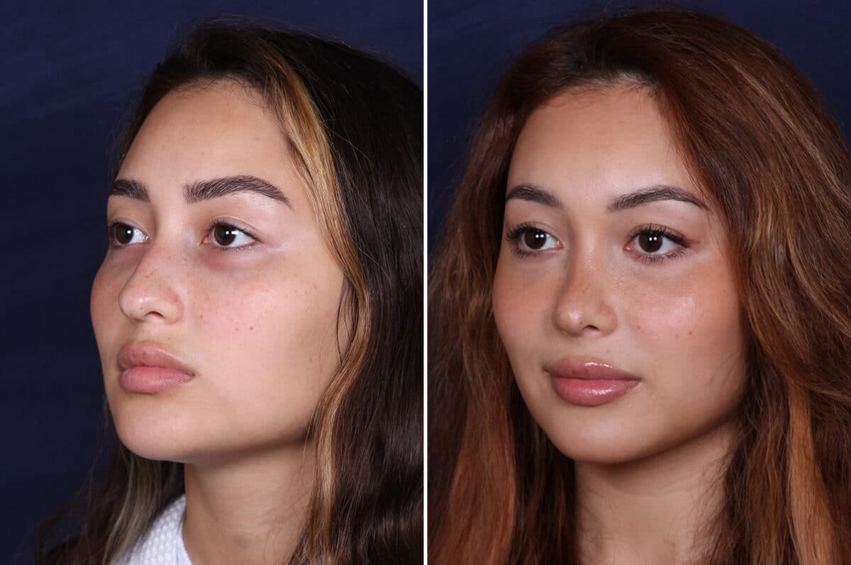 Rhinoplasty Before and After Photos in Voorhees Township, NJ, Patient 4079