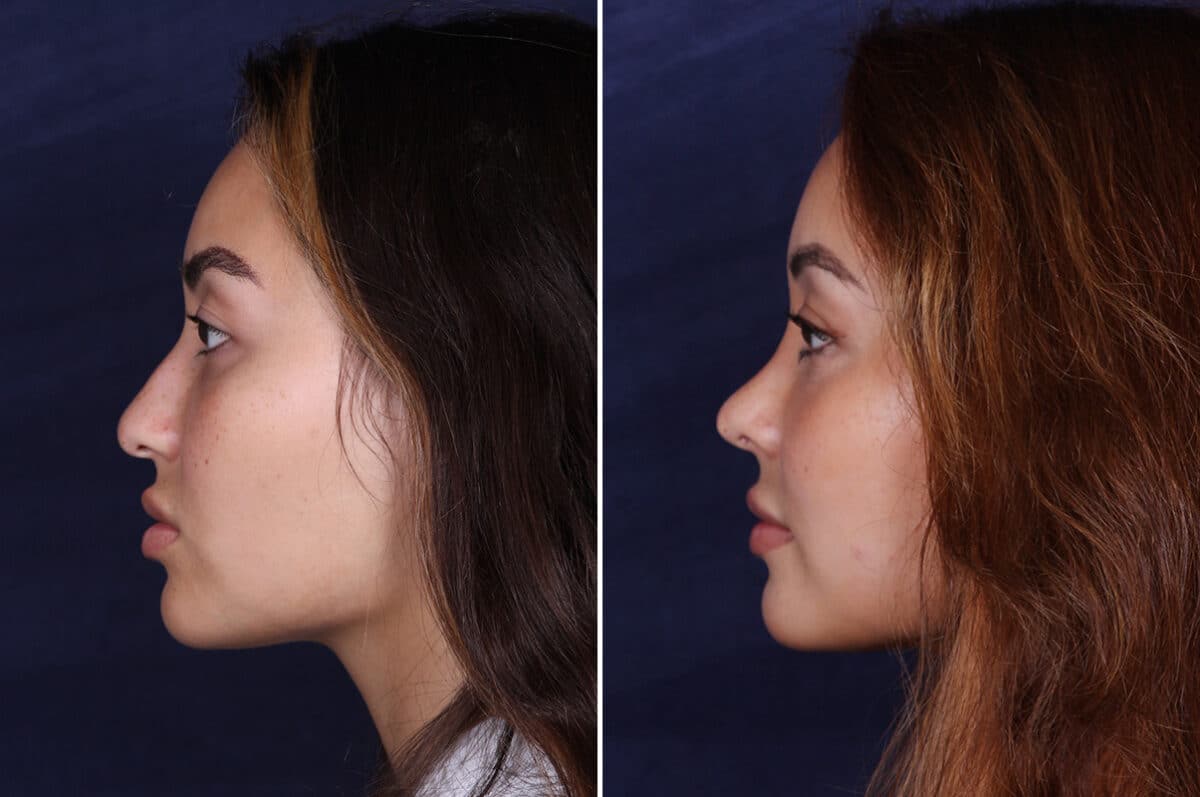 Rhinoplasty Before and After Photos in Voorhees Township, NJ, Patient 4079