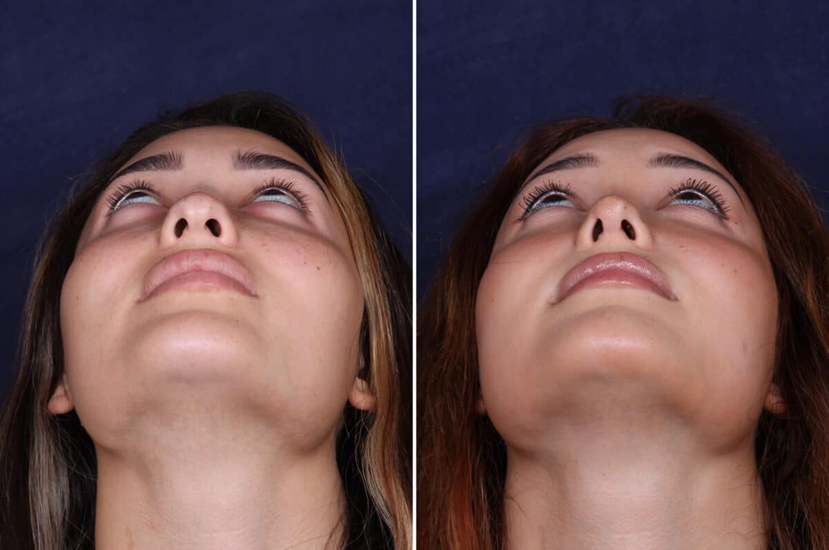 Rhinoplasty Before and After Photos in Voorhees Township, NJ, Patient 4079