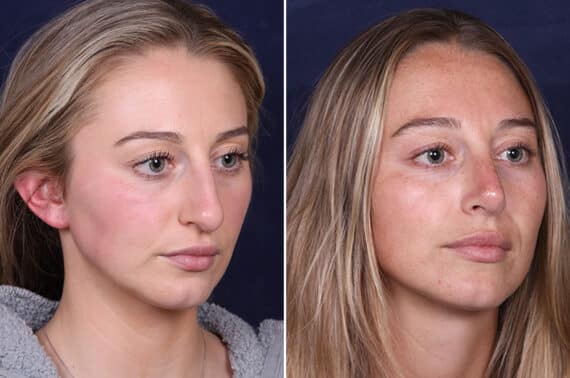 Rhinoplasty Before and After Photos in Voorhees Township, NJ, Patient 4098