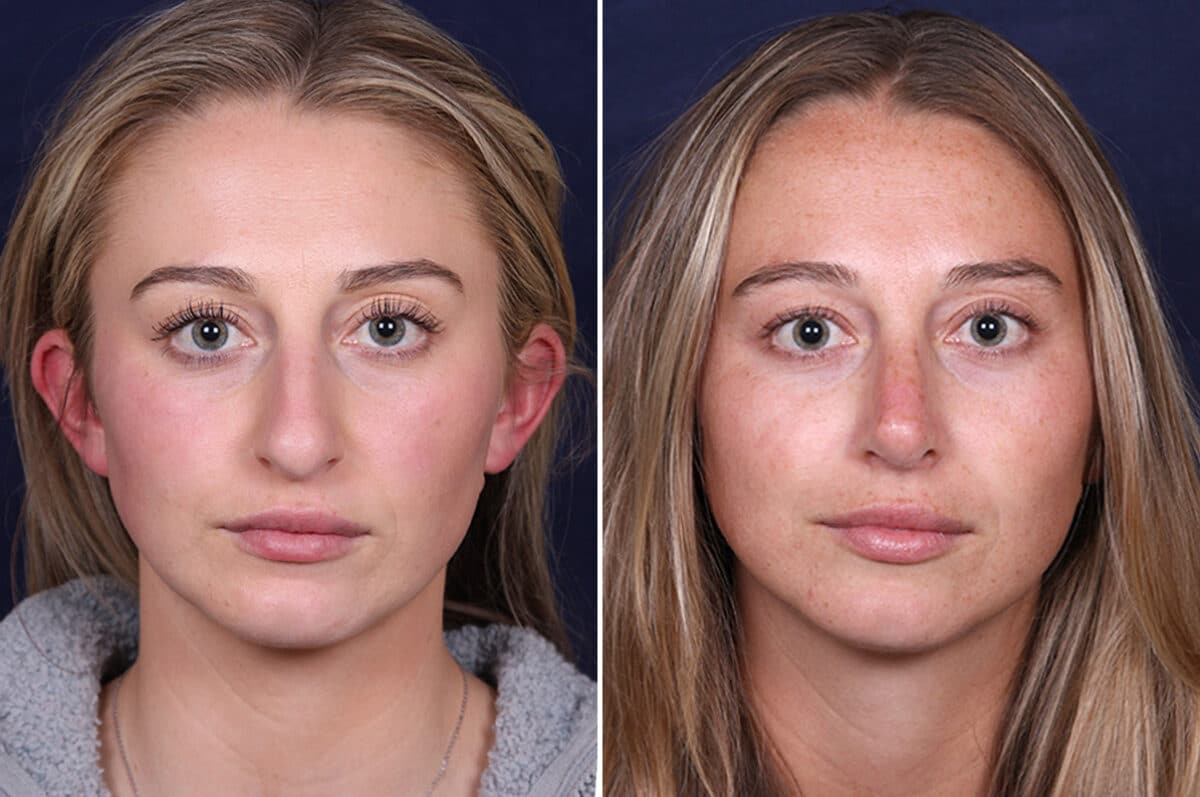 Rhinoplasty Before and After Photos in Voorhees Township, NJ, Patient 4098