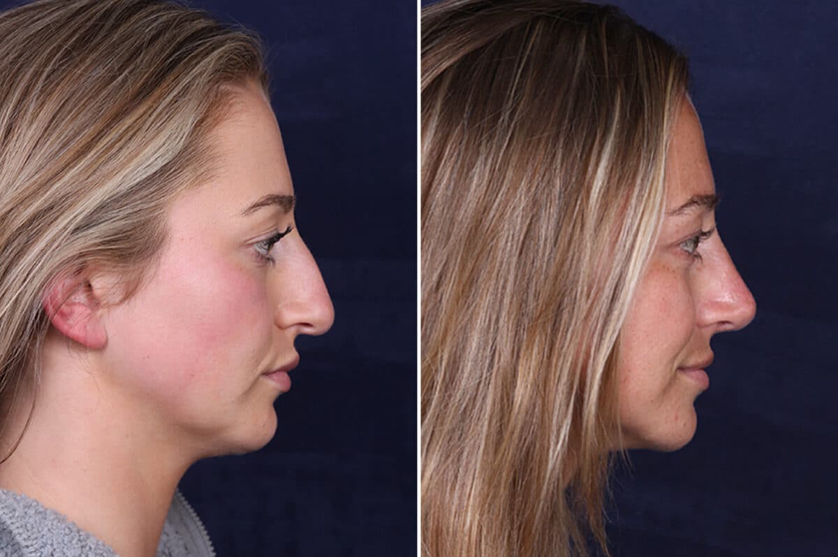 Rhinoplasty Before and After Photos in Voorhees Township, NJ, Patient 4098