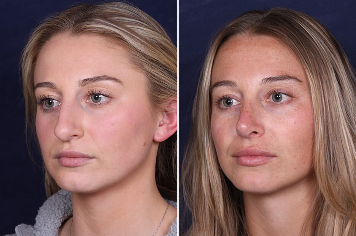 Rhinoplasty Before and After Photos in Voorhees Township, NJ, Patient 4098