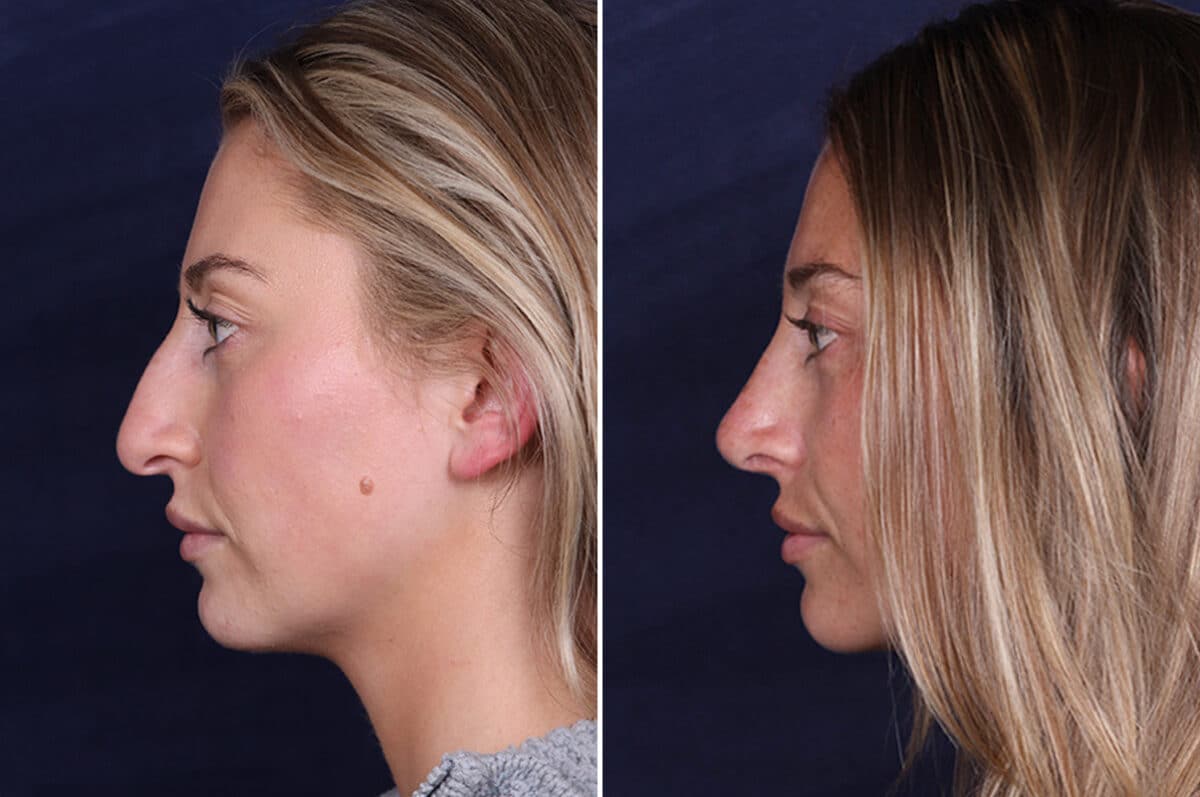 Rhinoplasty Before and After Photos in Voorhees Township, NJ, Patient 4098