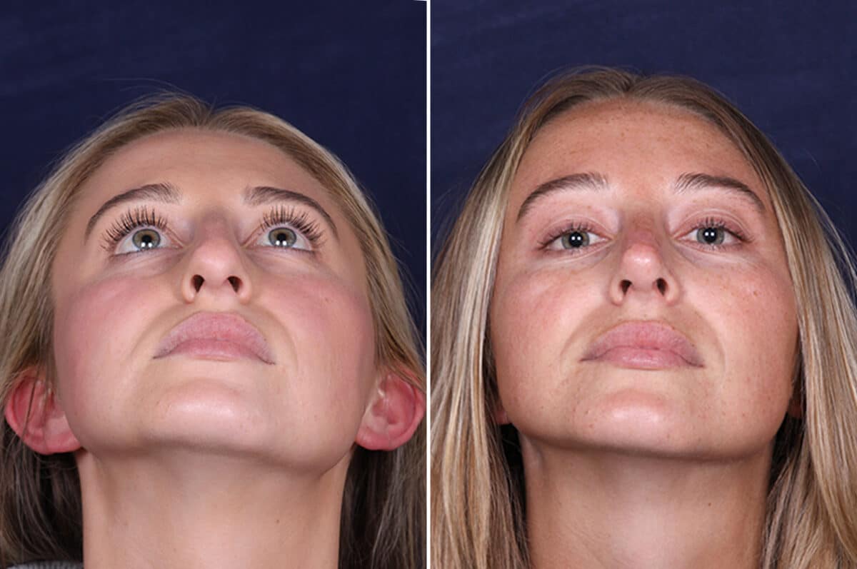 Rhinoplasty Before and After Photos in Voorhees Township, NJ, Patient 4098