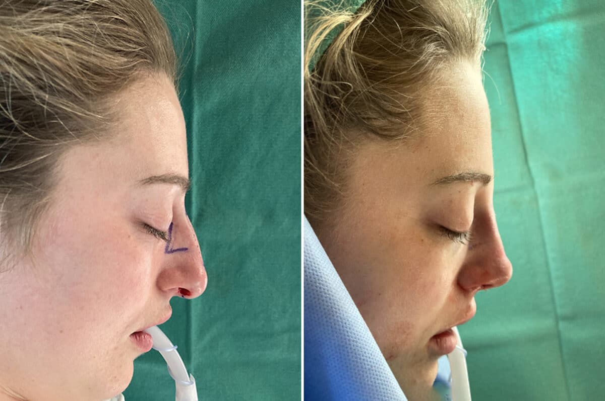 Rhinoplasty Before and After Photos in Voorhees Township, NJ, Patient 4098