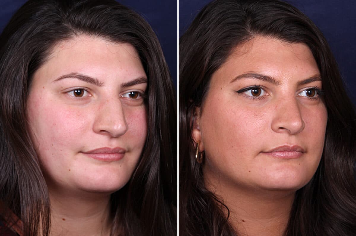 Rhinoplasty Before and After Photos in Voorhees Township, NJ, Patient 4120