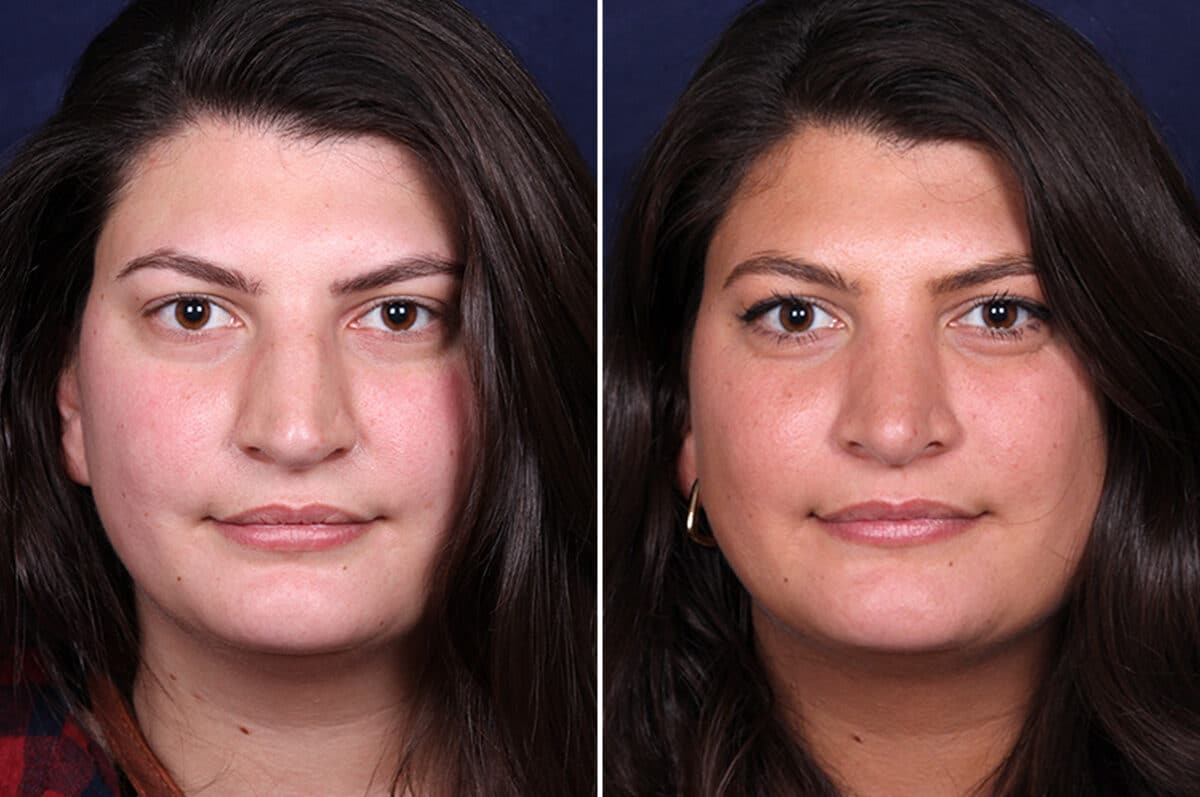 Rhinoplasty Before and After Photos in Voorhees Township, NJ, Patient 4120