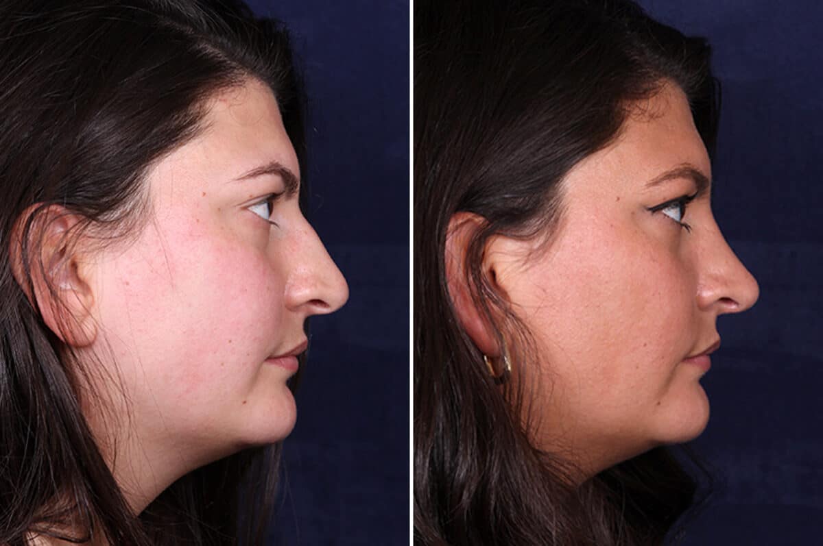 Rhinoplasty Before and After Photos in Voorhees Township, NJ, Patient 4120