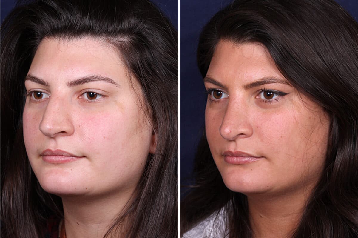 Rhinoplasty Before and After Photos in Voorhees Township, NJ, Patient 4120