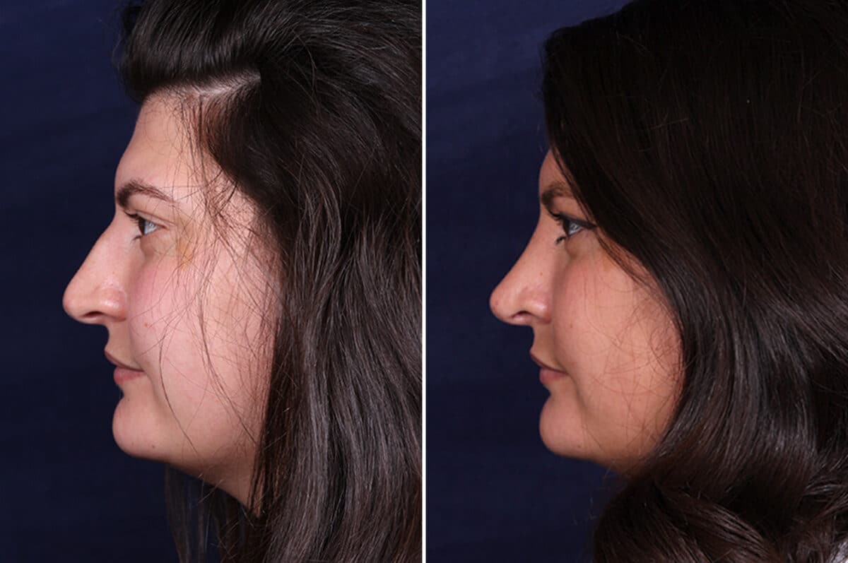 Rhinoplasty Before and After Photos in Voorhees Township, NJ, Patient 4120