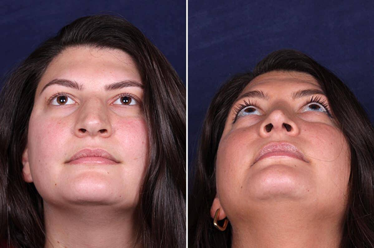 Rhinoplasty Before and After Photos in Voorhees Township, NJ, Patient 4120