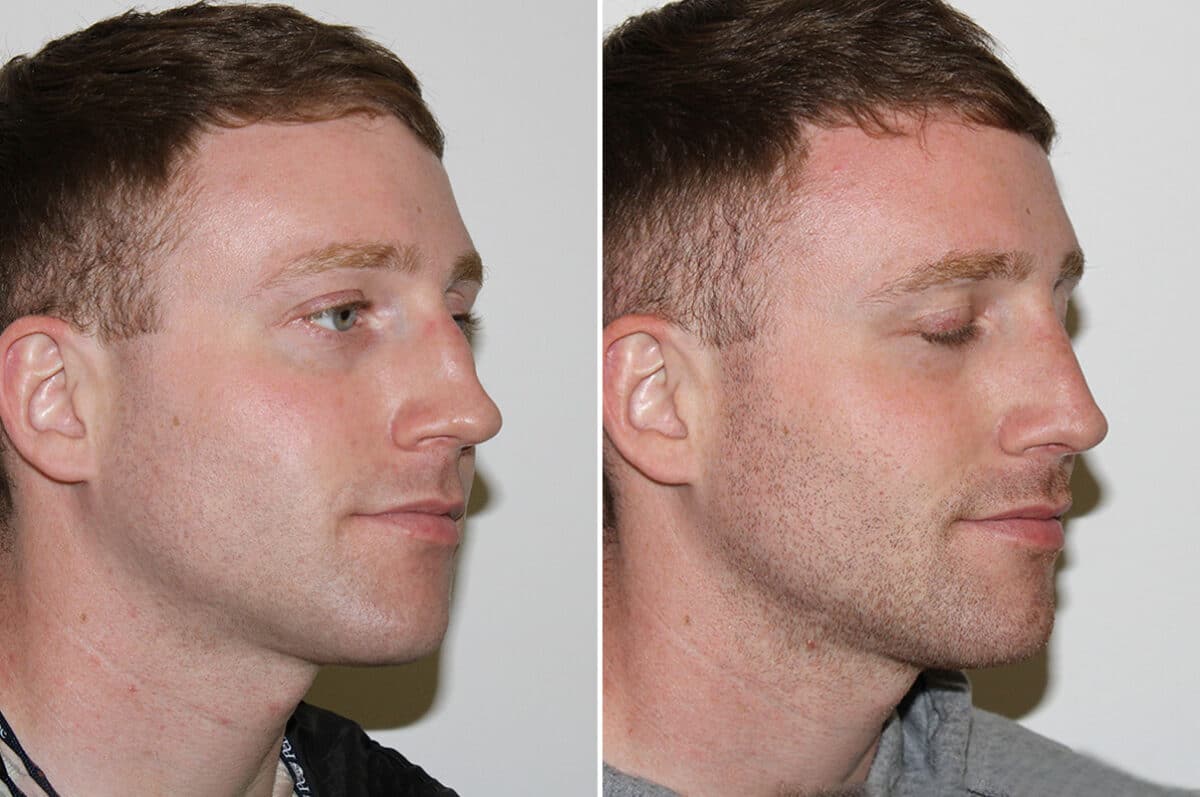 Rhinoplasty Before and After Photos in Voorhees Township, NJ, Patient 4139