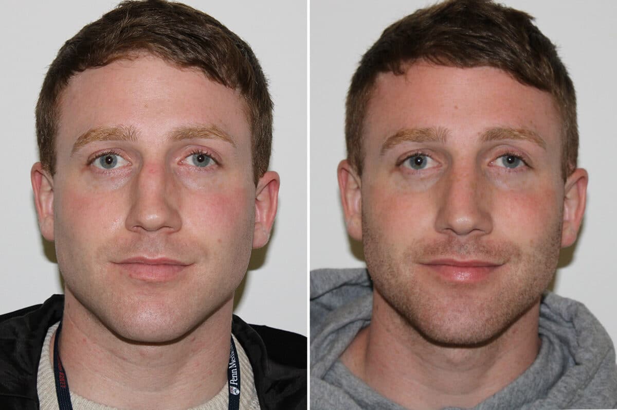 Rhinoplasty Before and After Photos in Voorhees Township, NJ, Patient 4139