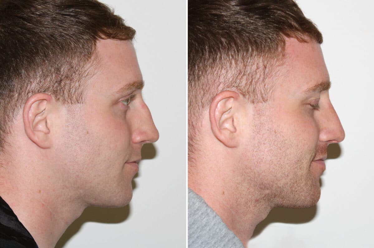 Rhinoplasty Before and After Photos in Voorhees Township, NJ, Patient 4139