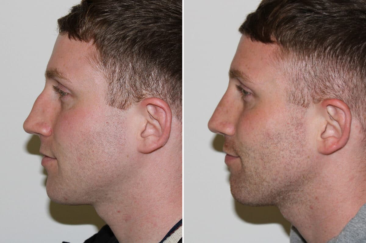 Rhinoplasty Before and After Photos in Voorhees Township, NJ, Patient 4139