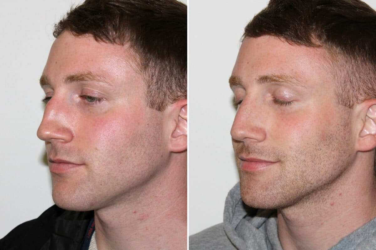 Rhinoplasty Before and After Photos in Voorhees Township, NJ, Patient 4139