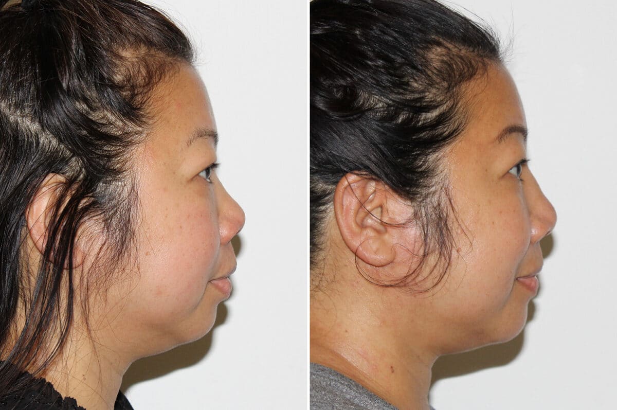 Submental Liposuction Before and After Photos in Voorhees Township, NJ, Patient 4171