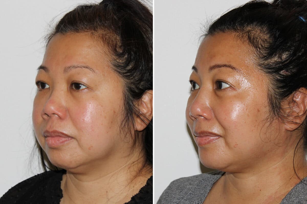 Submental Liposuction Before and After Photos in Voorhees Township, NJ, Patient 4171