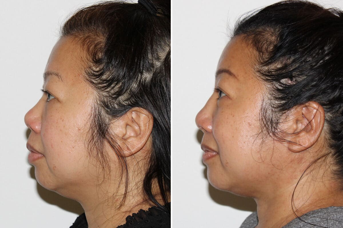 Submental Liposuction Before and After Photos in Voorhees Township, NJ, Patient 4171