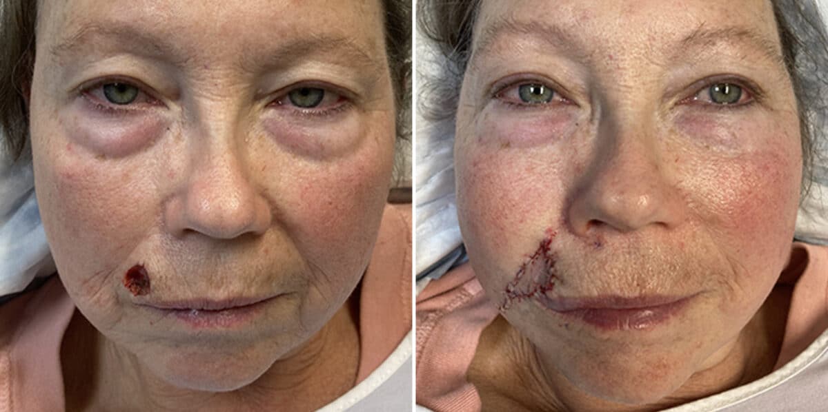 Mohs Reconstruction Before and After Photos in Voorhees Township, NJ, Patient 4192