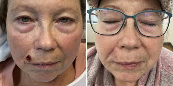 Mohs Reconstruction Before and After Photos in Voorhees Township, NJ, Patient 4192